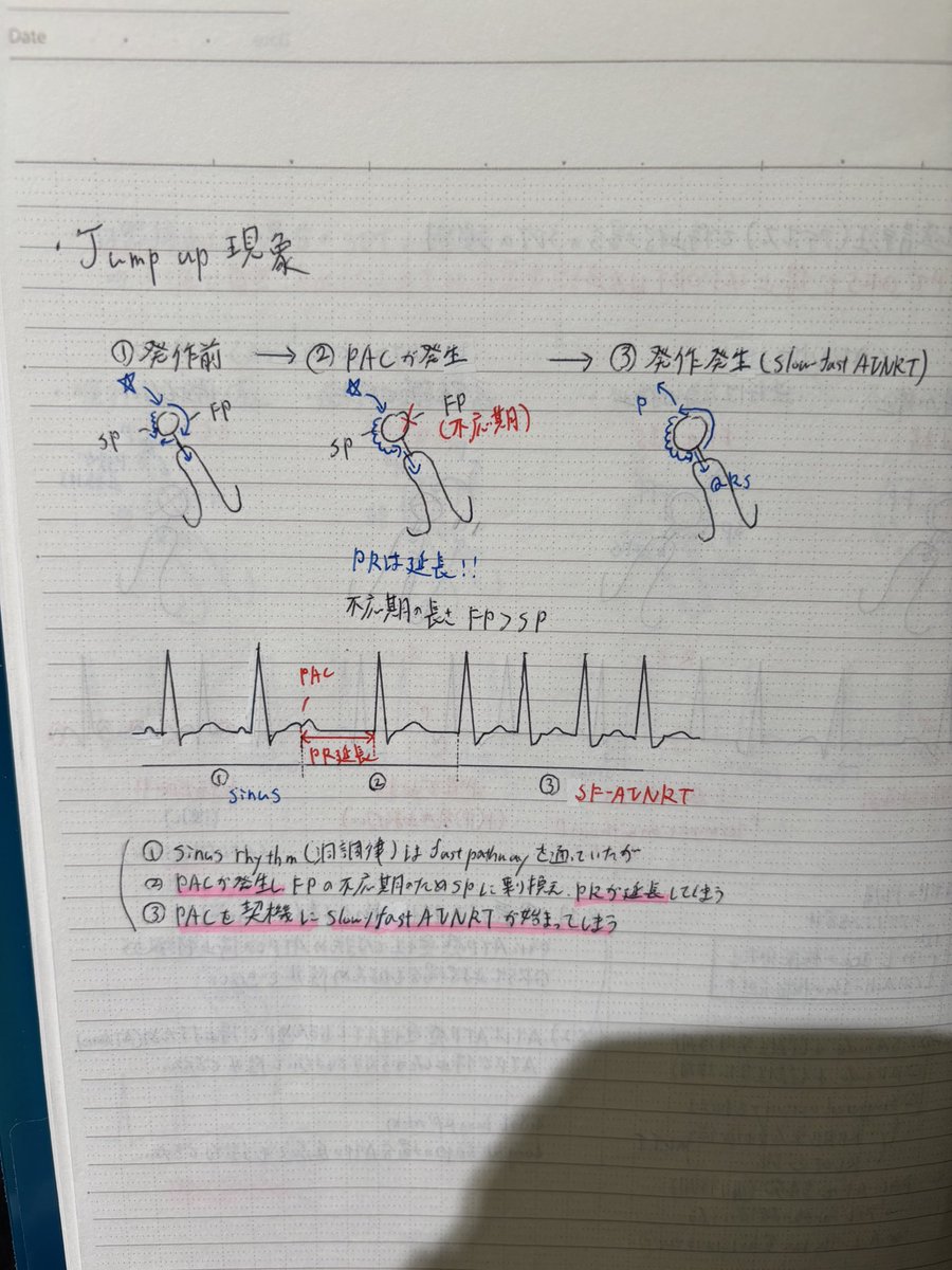 ★Jump up現象
①洞調律はfast pathwayを通ってたけど、②PACが発生しfast pathwayはまだ不応期で通れずslow pathwayに乗り換える事でPRが延長してしまうため
③PACを契機にslow-fast AVNRTが始まってしまう…!
→つまり、PRの著明な延長を伴いvery short RP'頻拍が開始してればSF AVNRTの可能性が高い