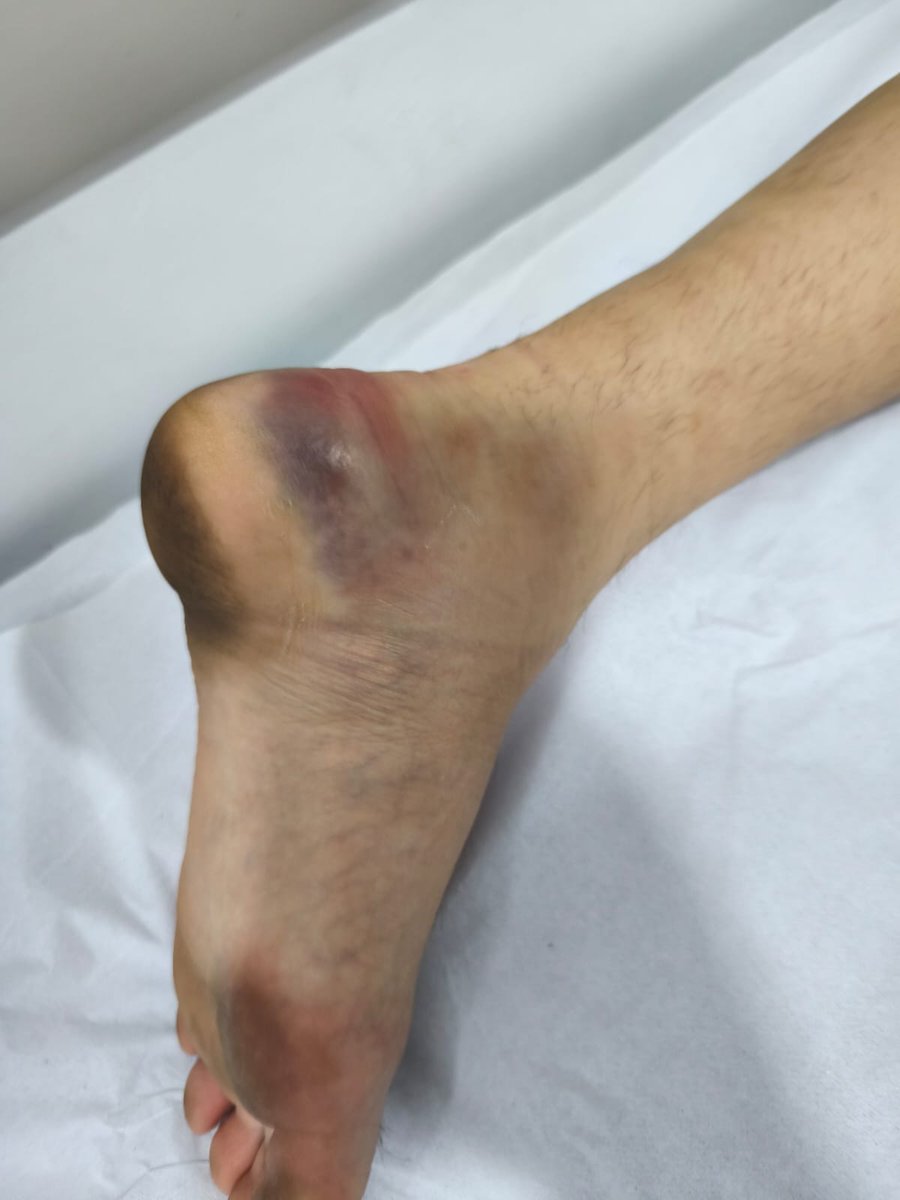 ContiGonza's tweet photo. #GodoyCruz
De los 5 detenidos en Brasil tras el partido vs Atlético Mineiro, uno sí tuvo heridas más graves y permanece internado por quebraduras en ambos pies. 
Deberá ser operado, en principio de uno de los dos.
Me cuentan, además, que a pesar de las lesiones evidentes lo hicieron salir del estadio caminando, lo cual empeoró todo.
En cuanto a los incidentes, quienes estuvieron ahí aseguran que no hubo ninguna agresión previa de hinchas del Tomba ni a la Seguridad ni a la Policía y que toda la violencia empezó "de la nada" y "sin motivos" cuando un Seguridad intentó detener a un hincha de manera violenta.
Teléfono, @CONMEBOL, siempre lo mismo en Brasil.