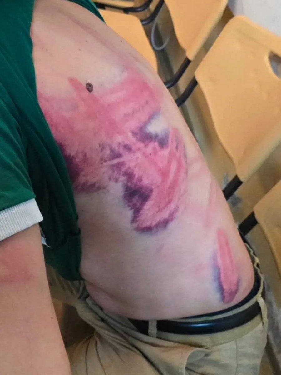 Kaže Vučić "hteli su žive da ih spale". A ove masnice su sami crtali, ili ih je neko tukao?