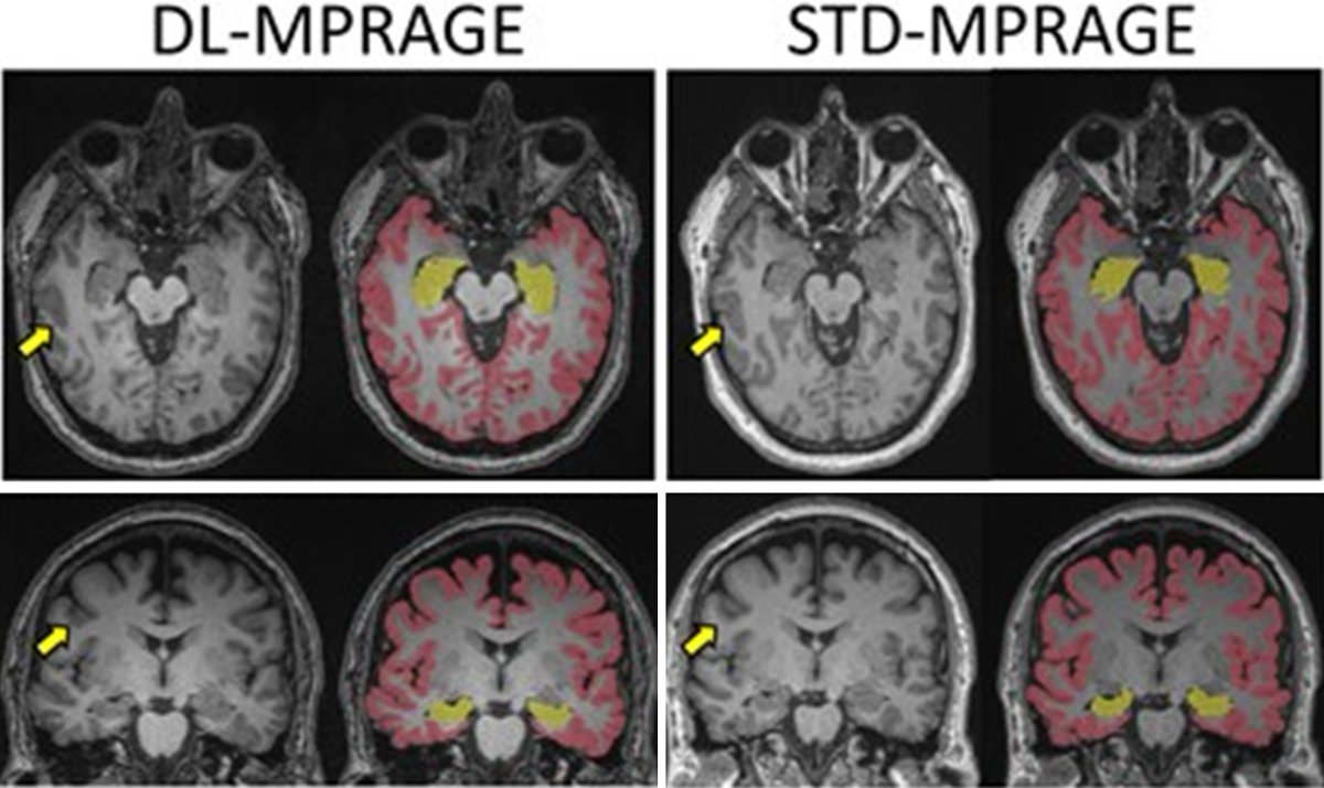 Asser Abou Elkassem (@asser_ae) on Twitter photo Deep learning-accelerated T1-MPRAGE cuts brain MRI scan time, improves spatial resolution, and delivers equivalent volumetric estimates with similar delineation of sulci and gyri .
<a href="/SusannaLeeRad/">Susanna I Lee</a> <a href="/OxfordJournals/">Oxford Journals</a> #RadAdv
doi.org/10.1093/radadv… Deep learning-accelerated T1-MPRAGE cuts brain MRI scan time, improves spatial resolution, and delivers equivalent volumetric estimates with similar delineation of sulci and gyri .
<a href="/SusannaLeeRad/">Susanna I Lee</a> <a href="/OxfordJournals/">Oxford Journals</a> #RadAdv
doi.org/10.1093/radadv…