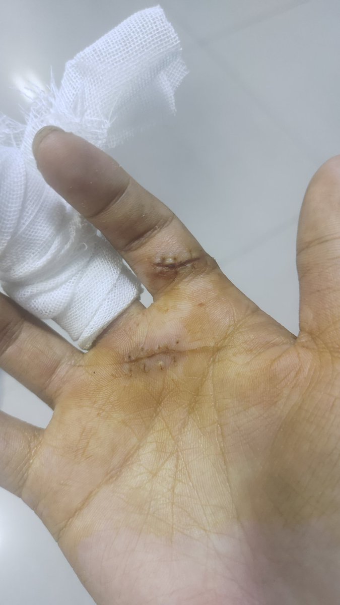 User066602's tweet photo. 昨天刚拆完线，还不知道什么时候可以碰水，身上黏糊糊的好难受，在外面晒完之后又回家里休息，这几天都在褪皮 https://t.co/fvjmRHj1Uy