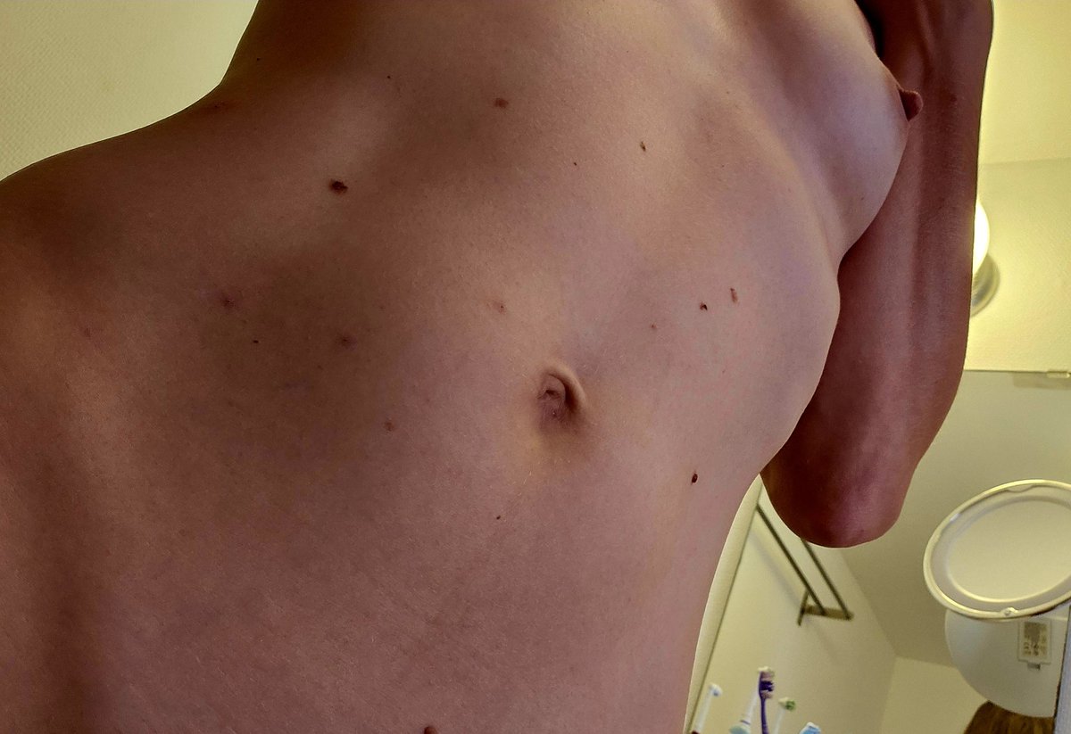 LPChlo's tweet photo. Les moustiques ne m'ont pas raté...
Et pas que sur le ventre...😖
Bref, tout le monde s'en fout mais ça gratte 😅 

Bon #VendrediSeins à toutes et tous 😘 https://t.co/gHj30M7fMk