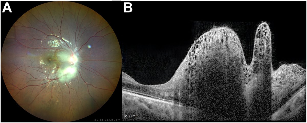 A 13yo girl presented with headache for 1 week of vomiting, fever, knee pain. She was was 20/40 right eye and 20/20 left eye. There was relative afferent pupillary defect in the right eye. Exam showed a juxtapapillary elevated lesion with calcification 
ow.ly/AFXU50WpSW8