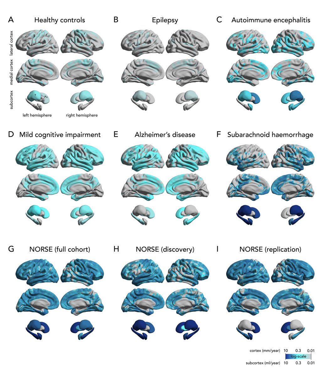 GalovicMarian's tweet photo. 🧠 Pop quiz: Which disorder eats away brain volume fastest?
A) Alzheimer’s disease
B) Subarachnoid hemorrhage
C) Autoimmune encephalitis
D) Status epilepticus
(Answer below 👇) https://t.co/mHoadNIXH4