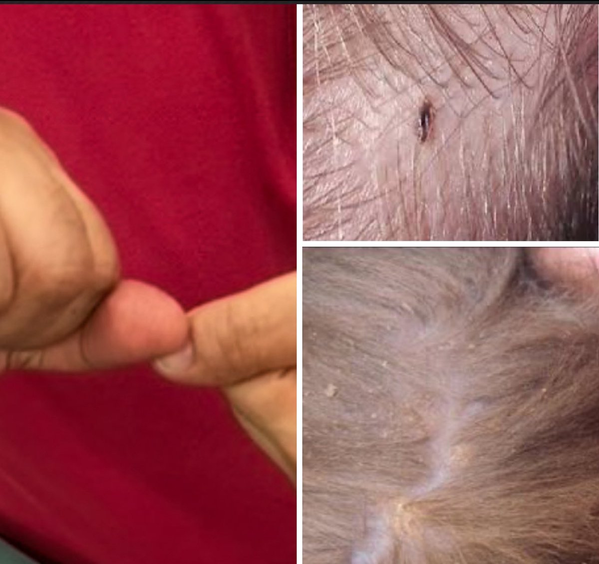 هذي طريقة قتل القمل قديما  🕷️🕷️    منو يعرف اسمها!!؟