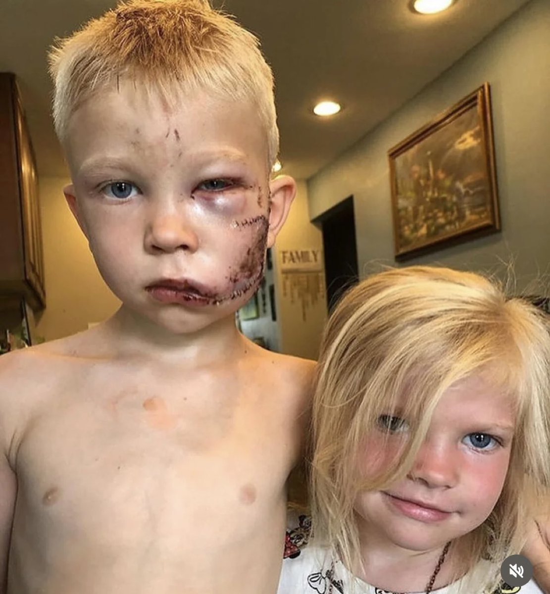 6-year-old Bridger Walker saved his little sister from a dog attack, stepping between them and taking the bites himself.

He needed nearly 90 stitches, but later said, “If someone had to die, I thought it should be me.”❤️