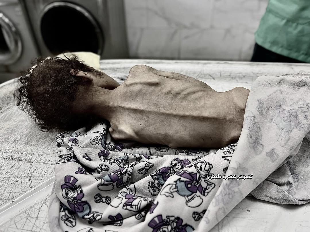 EyeonPalestine's tweet photo. Today, the United Nations officially declared that Gaza has entered famine.
And this is not just numbers or reports — it is the faces of children whose bodies have turned into skeletons. Some have already died of hunger, while others are waiting for their fate.
In Gaza, children go to bed hungry for nights on end, their tiny hearts stopping because food and medicine are forbidden.
These are not scenes from history, but a crime being committed right now in front of a silent world.
Every image is a cry for help, a call for life from Gaza to all of humanity:
Stop the famine. Save the children. Before an entire generation vanishes before your eyes.

اليوم أعلنت الأمم المتحدة رسميًا دخول غزة في المجاعة، وهذه ليست مجرد أرقام أو تقارير، بل وجوه أطفال أصبحوا هياكل عظمية، بعضهم رحل
جوعًا، وآخرون ينتظرون مصيرهم.
في غزة، ينام الأطفال لليال طويلة بلا طعام، تتوقف قلوبهم الصغيرة لأن
الغذاء والدواء ممنوع.
هذه ليست مشاهد من التاريخ، بل جريمة ترتكب الآن أمام صمت العالم، كل صورة هنا هي استغاثة.. نداء حياة من غزة إلى الإنسانية جمعاء: أوقفوا المجاعة، أنقذوا الأطفال، قبل أن يفنى جيل كامل أمام أعينكم.