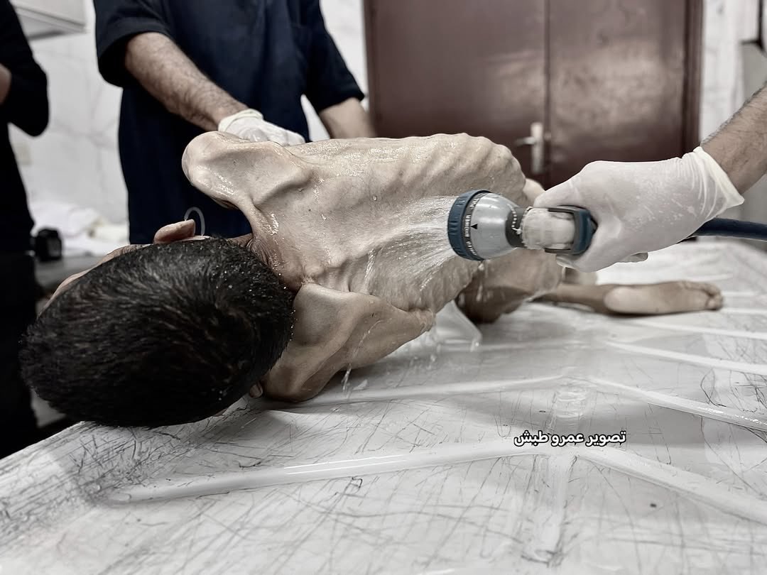 EyeonPalestine's tweet photo. Today, the United Nations officially declared that Gaza has entered famine.
And this is not just numbers or reports — it is the faces of children whose bodies have turned into skeletons. Some have already died of hunger, while others are waiting for their fate.
In Gaza, children go to bed hungry for nights on end, their tiny hearts stopping because food and medicine are forbidden.
These are not scenes from history, but a crime being committed right now in front of a silent world.
Every image is a cry for help, a call for life from Gaza to all of humanity:
Stop the famine. Save the children. Before an entire generation vanishes before your eyes.

اليوم أعلنت الأمم المتحدة رسميًا دخول غزة في المجاعة، وهذه ليست مجرد أرقام أو تقارير، بل وجوه أطفال أصبحوا هياكل عظمية، بعضهم رحل
جوعًا، وآخرون ينتظرون مصيرهم.
في غزة، ينام الأطفال لليال طويلة بلا طعام، تتوقف قلوبهم الصغيرة لأن
الغذاء والدواء ممنوع.
هذه ليست مشاهد من التاريخ، بل جريمة ترتكب الآن أمام صمت العالم، كل صورة هنا هي استغاثة.. نداء حياة من غزة إلى الإنسانية جمعاء: أوقفوا المجاعة، أنقذوا الأطفال، قبل أن يفنى جيل كامل أمام أعينكم.