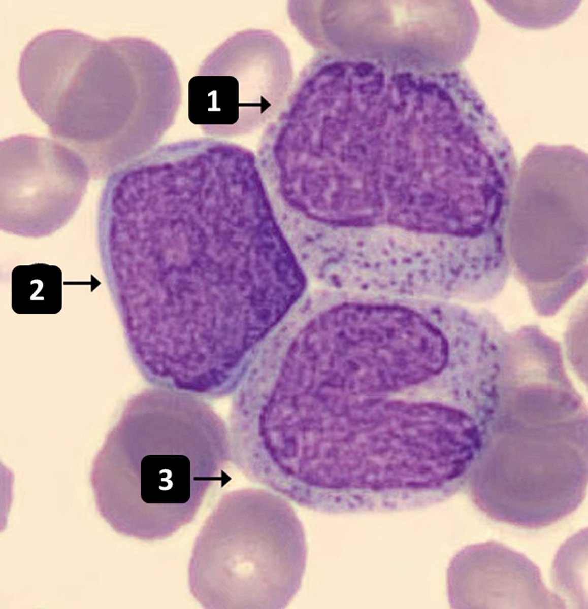 #1, #2, and #3, who are we?

Master their morphology in this fun tutorial
⬇️⬇️
pathologynotebook.com/myeloid03
⬆️⬆️

#Pathology #Hematology #PathTwitter #HemePath