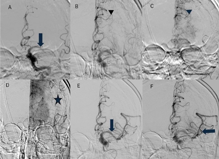 Journal of Neuroimaging (@jneuroimaging) on Twitter photo Advances in Collateral Neuroimaging for Acute Ischemic Stroke: Redefining Time and Tissue Windows in the Reperfusion Era
onlinelibrary.wiley.com/doi/full/10.11…
#neuroimaging #neurology #neurotwitter #neurorad #radres <a href="/WileyNeuro/">Wiley Neuro</a> <a href="/asneuroimaging/">American Society of Neuroimaging</a> #collateralimaging #stroke #Mri
Free read Advances in Collateral Neuroimaging for Acute Ischemic Stroke: Redefining Time and Tissue Windows in the Reperfusion Era
onlinelibrary.wiley.com/doi/full/10.11…
#neuroimaging #neurology #neurotwitter #neurorad #radres <a href="/WileyNeuro/">Wiley Neuro</a> <a href="/asneuroimaging/">American Society of Neuroimaging</a> #collateralimaging #stroke #Mri
Free read