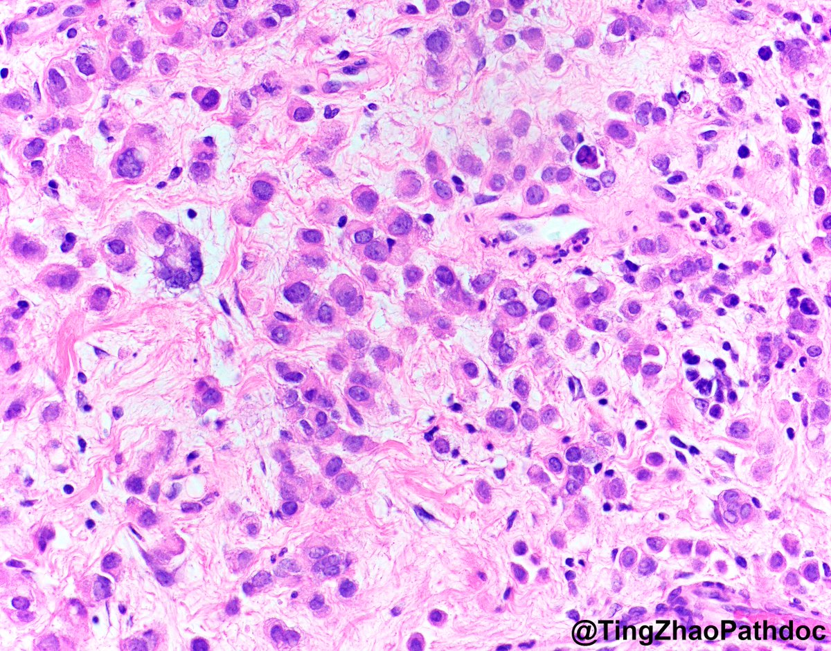 TingZhaoPathdoc's tweet image. 40s M, what is your diagnosis?
#PathTwitter
@MGBpathology @MGHPathology