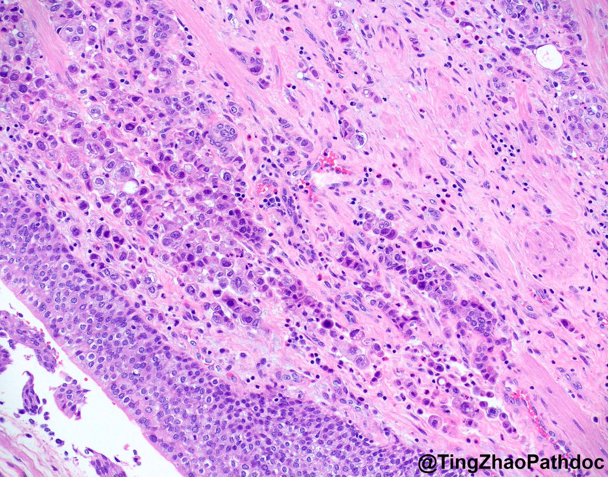 TingZhaoPathdoc's tweet image. 40s M, what is your diagnosis?
#PathTwitter
@MGBpathology @MGHPathology
