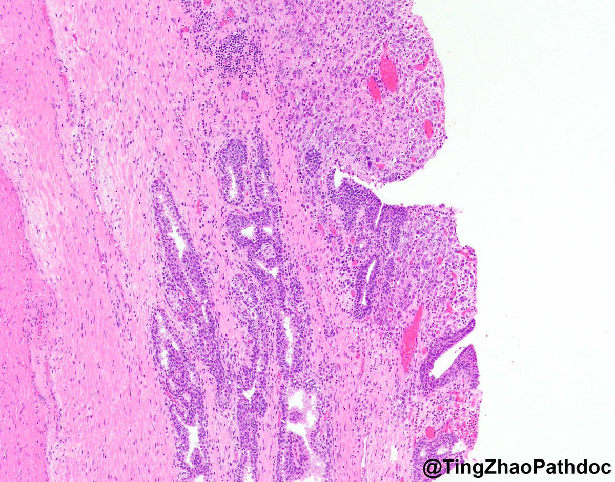 TingZhaoPathdoc's tweet image. 40s M, what is your diagnosis?
#PathTwitter
@MGBpathology @MGHPathology