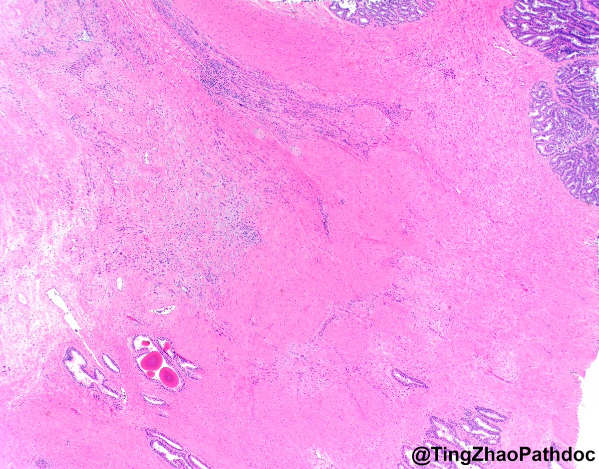 Ting Zhao, MD (@tingzhaopathdoc) on Twitter photo 40s M, what is your diagnosis?
#PathTwitter
<a href="/MGBpathology/">Mass General Brigham Pathology</a> <a href="/MGHPathology/">MGH Pathology</a> 40s M, what is your diagnosis?
#PathTwitter
<a href="/MGBpathology/">Mass General Brigham Pathology</a> <a href="/MGHPathology/">MGH Pathology</a>