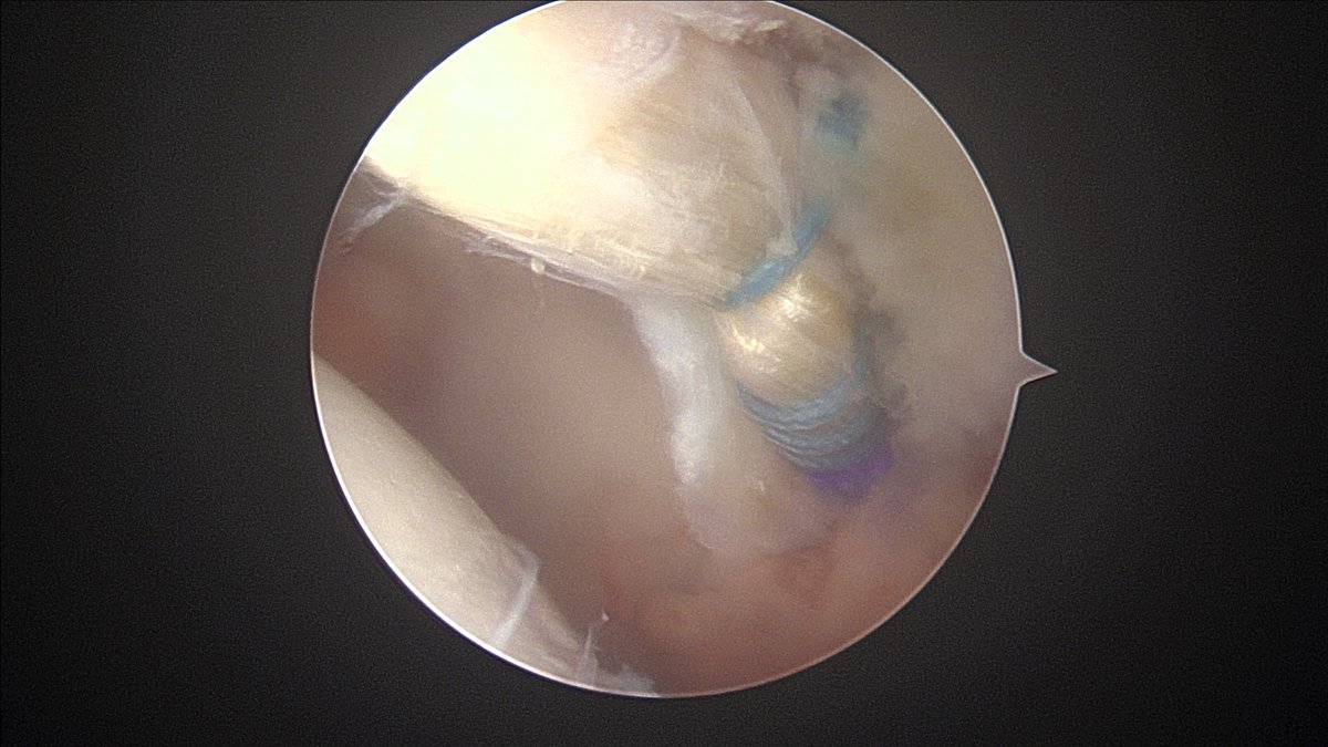 In young patients with degenerative labral tears, my preference is to reconstruct the labrum primarily, along with treating the #HipFAI. 1st pic-labrum tear. 2nd pic-putting in graft. 3rd pic-anterior labral recon. 4th pic-posterior labral recon. #HipArthroscopy