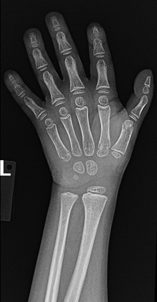 An interesting finding in fanconi anemia is a triphalngeal thumb 

Al Salam H, Lustosa L, Ranchod A, et al. Triphalangeal thumb. Reference article, Radiopaedia.org (Accessed on 15 Aug 2025) doi.org/10.53347/rID-1…