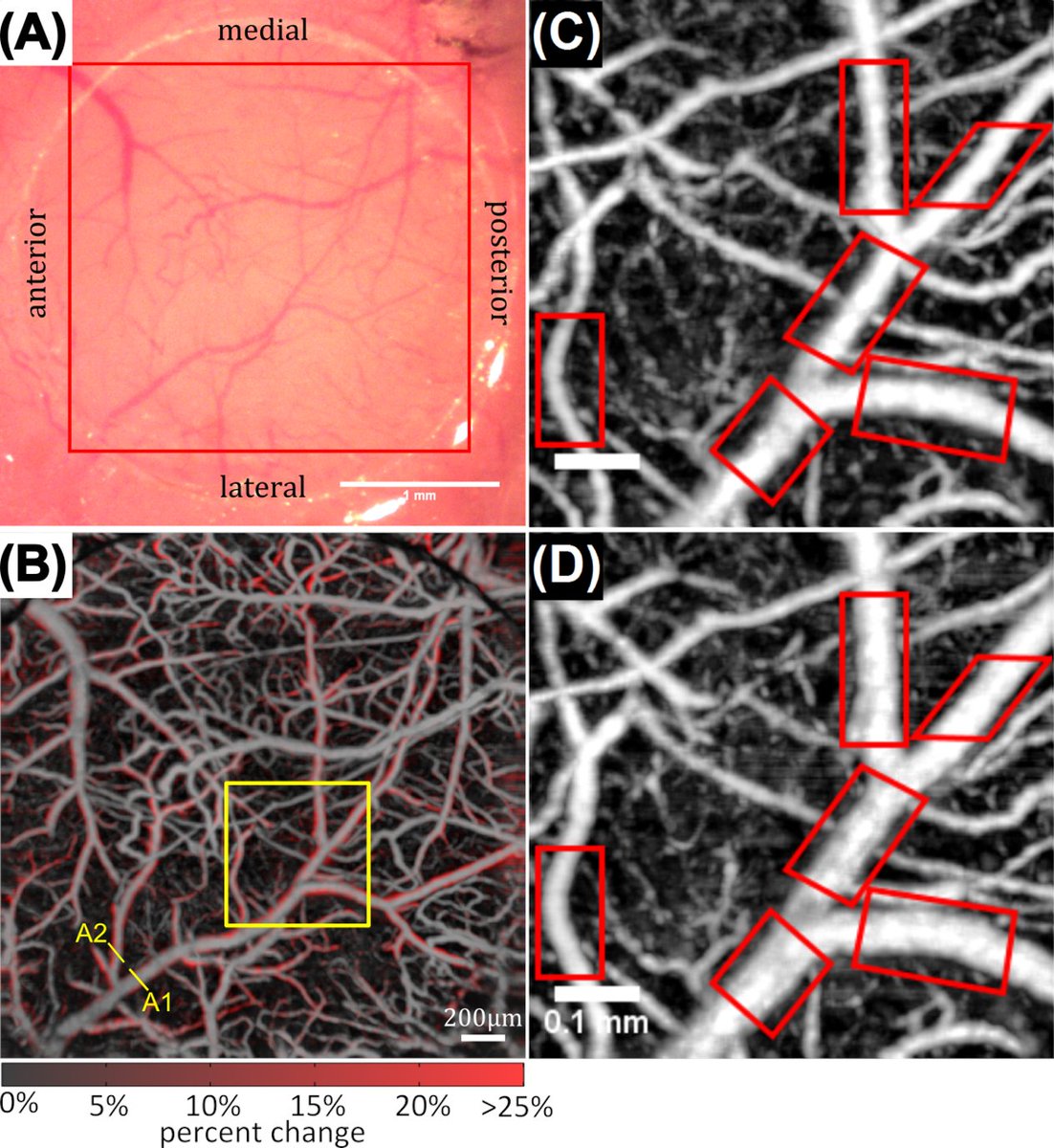FAU engineers + I-SENSE researchers have mapped how the brain’s tiniest blood vessels protect against damage.

Their model could lead to earlier detection of Alzheimer’s — and better treatments for stroke &amp; brain injury. 🧠💡

🔗fau.edu/newsdesk/artic…