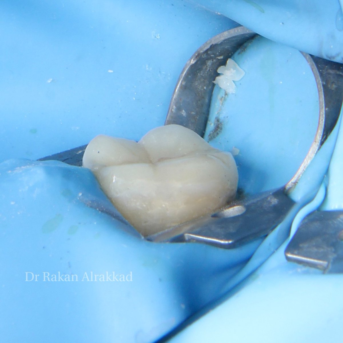 E-max Endocrown for #36 😍🤍
All procedure done under rubber dam 
IDS , surface treatments and cementation 

تلبسية جزئية من مادة الخزف للحفاظ على الضرس بعد علاج العصب 🦷
