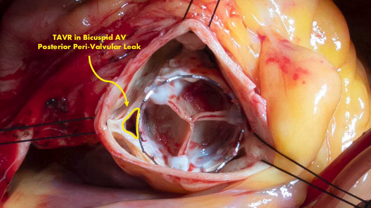 Anthony Zaki, MD (@anthonyzakimd) on Twitter photo IntraOp Pic: TAVR with large posterior PVL w/ hemolysis + AI. Successful TAVR explant, AVR + root enlargement + Asc Ao repair. Consider upfront SAVR especially for low-risk patients with bicuspid valves with aortic disease!
<a href="/ClevelandClinic/">Cleveland Clinic</a> <a href="/CleClinicHVTI/">Cleveland Clinic Heart, Vascular & Thoracic</a> #aortaed #CardioEd IntraOp Pic: TAVR with large posterior PVL w/ hemolysis + AI. Successful TAVR explant, AVR + root enlargement + Asc Ao repair. Consider upfront SAVR especially for low-risk patients with bicuspid valves with aortic disease!
<a href="/ClevelandClinic/">Cleveland Clinic</a> <a href="/CleClinicHVTI/">Cleveland Clinic Heart, Vascular & Thoracic</a> #aortaed #CardioEd