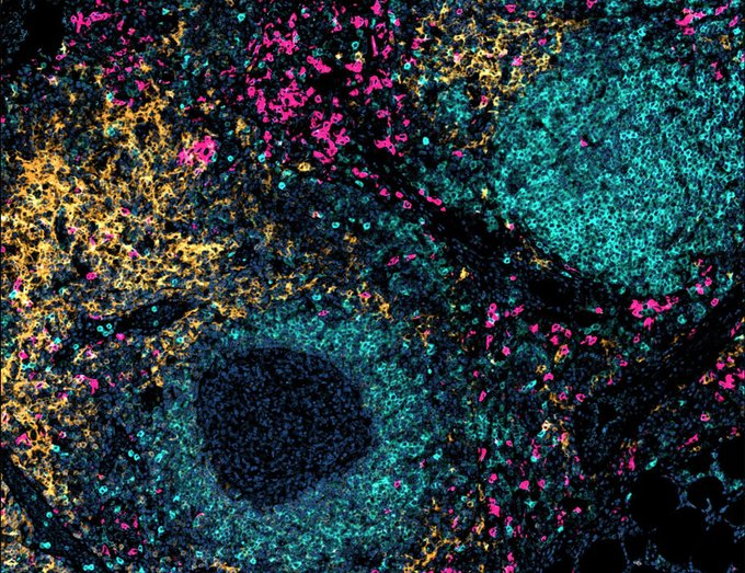 Waggoner Lab (@labwaggoner) on Twitter photo Flt3L and CD40 agonism enhance dendritic cell immunosurveillance in human and murine pancreatic cancer and engage type I immunity <a href="/SciImmunology/">Science Immunology</a>
science.org/doi/10.1126/sc… <a href="/DeNardoLabWUSM/">David DeNardo WUSM</a> Flt3L and CD40 agonism enhance dendritic cell immunosurveillance in human and murine pancreatic cancer and engage type I immunity <a href="/SciImmunology/">Science Immunology</a>
science.org/doi/10.1126/sc… <a href="/DeNardoLabWUSM/">David DeNardo WUSM</a>