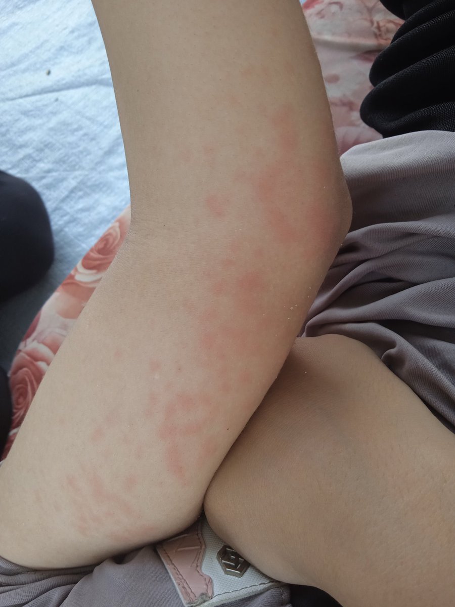 I was able to collect only $75 out of the $250 needed for my sister’s treatment. Please help me complete the amount so she can get the care she needs.
chuffed.org/project/130466
<a href="/roundthefurr/">shayma</a> 
<a href="/1drcole/">Dr. Cole #Resister</a> 
<a href="/ireallyhateyou/">B.M.</a>
<a href="/MothTongue_/">𓂆🔻لسان العثة @gazafunds.com</a>