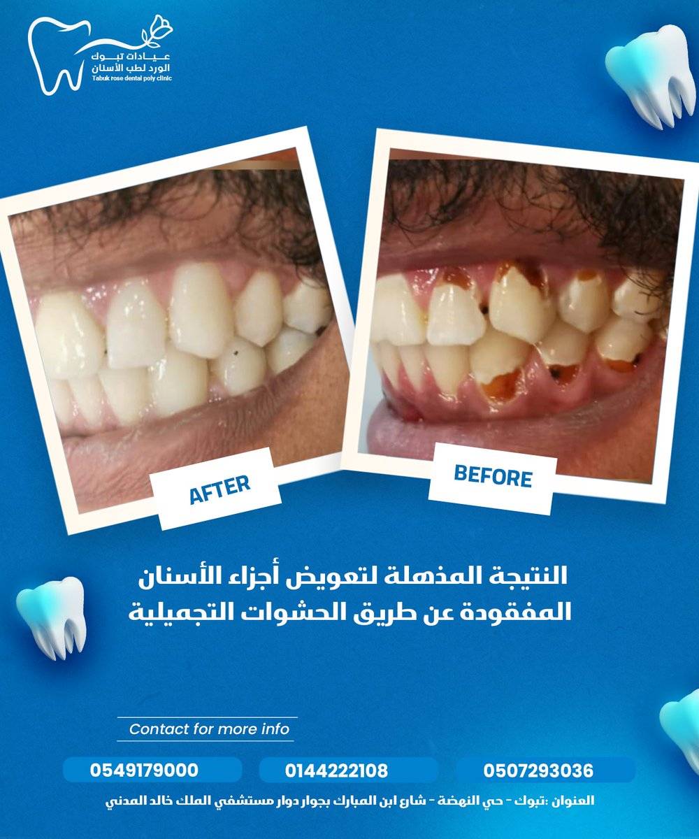 tabuk_dental1's tweet image. النتيجة المذهلة لتعويض أجزاء الأسنان المفقودة عن طريق الحشوات التجميلية
ننتظركم في تبوك الورد للحصول علي أسنان صحية وابتسامة من الخيال
*****