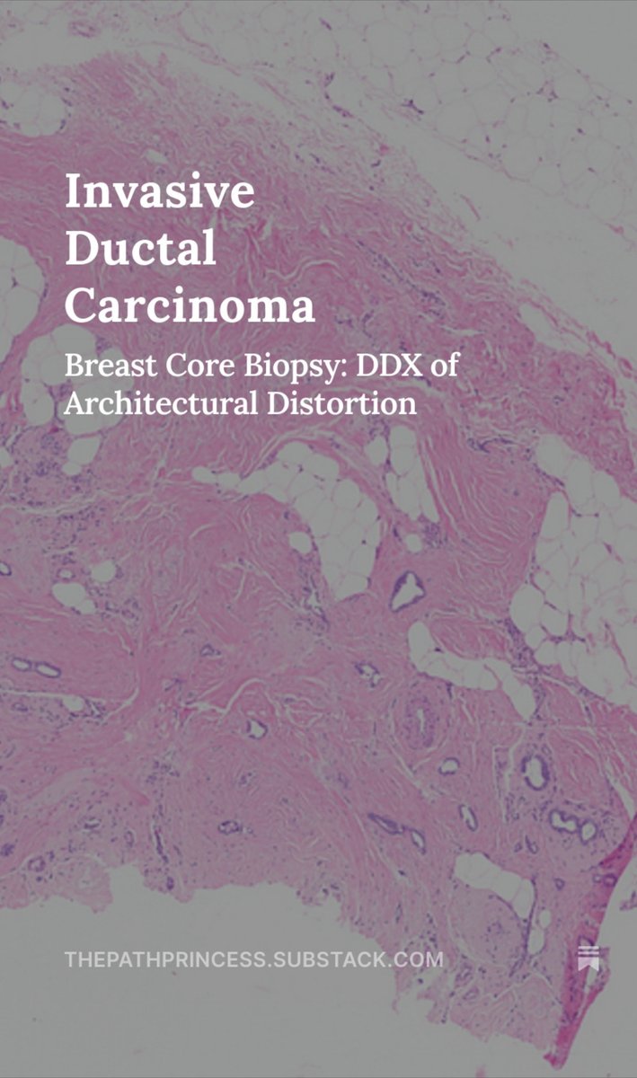 Invasive ductal carcinoma is a rare but subtle finding when associated with architectural distortion.👇

thepathprincess.substack.com/p/invasive-duc…

Don't miss the angulated invasive glands!

#pathology #pathologists #breastpathology #PathTwitter #PathX #breastpath