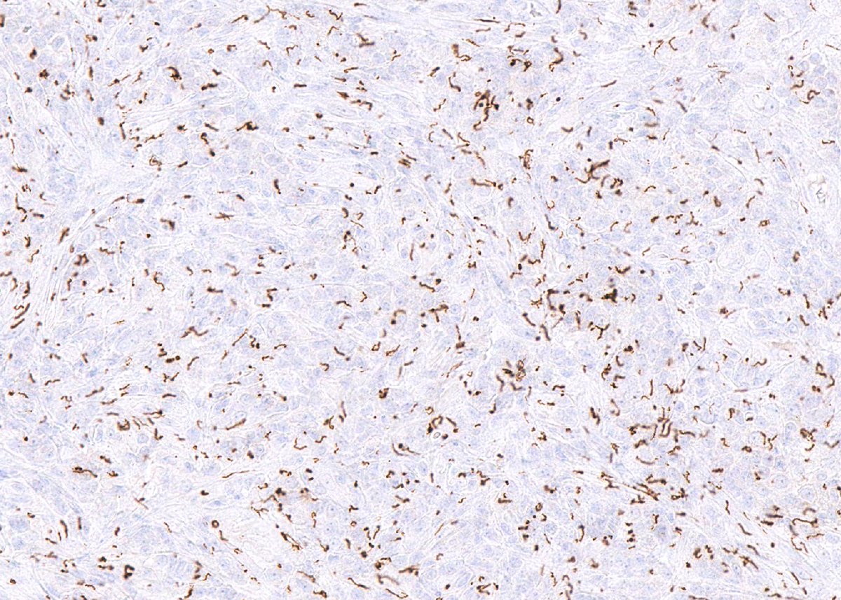 Course Director Dr. Anamarija Perry shared this case to be presented at our upcoming Challenges in Hematopathology course. my.uscap.org/app/program/Tw…

Clinical history: 
44yo with inguinal lymphadenopathy

Figures 1-3: H&amp;E 
Figure 4: Spirochete immunohistochemical stain

#PathX