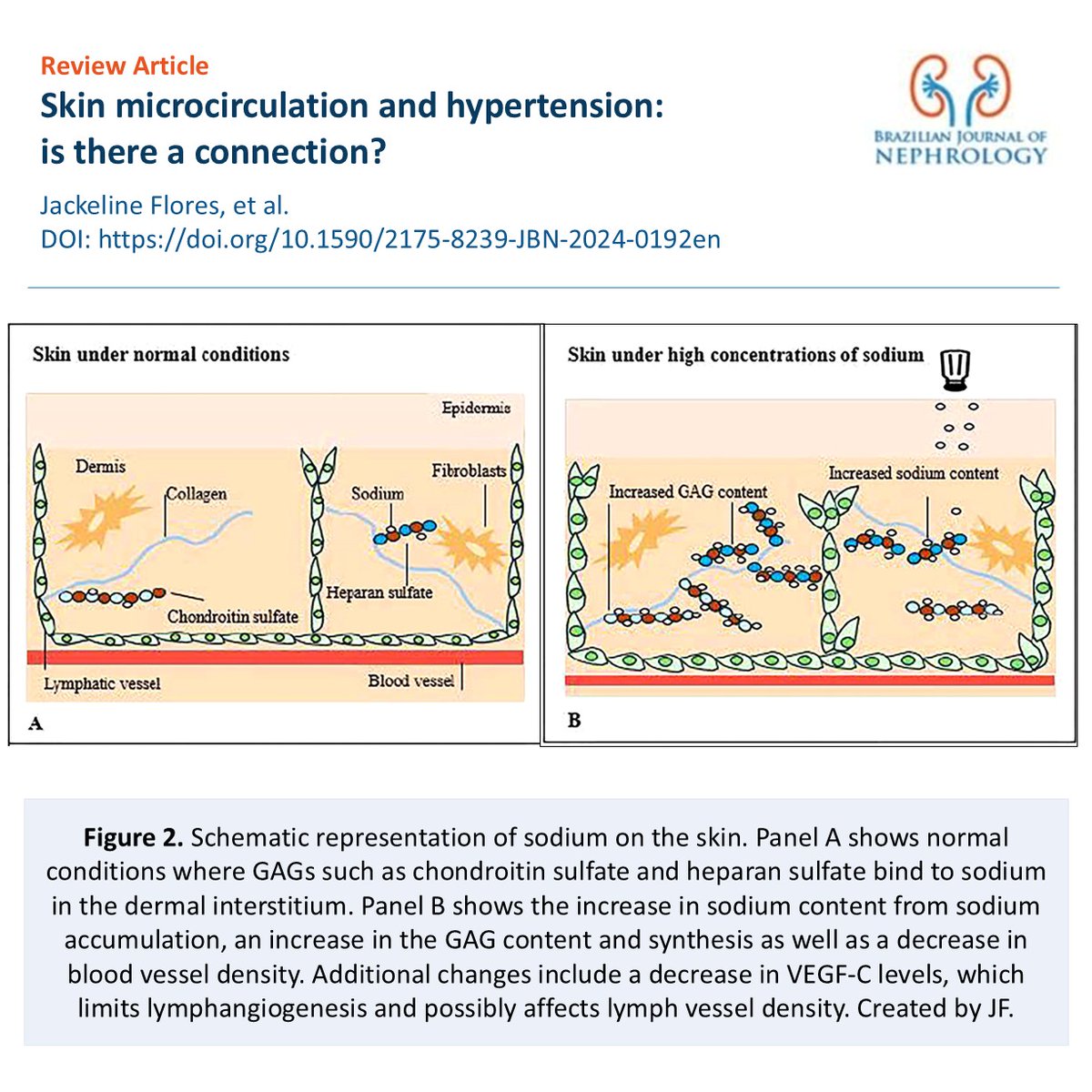 BJNephrology's tweet photo. 🧂📉 Review explores the role of the skin in hypertension: microvascular rarefaction, sodium storage, and transepidermal water loss influence blood pressure. The skin emerges as a key modulator in the pathophysiology of hypertension.

🔗 https://t.co/qvZwgbRdBC https://t.co/zb5BAFh14p