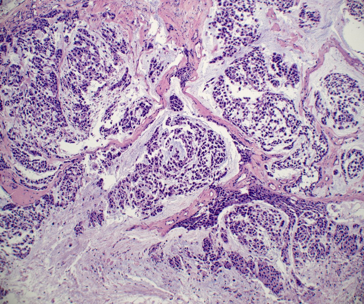 slusagar's tweet photo. #GUpath TURBT:

while not a formal urothelial carcinoma subtype (yet!), urothelial carcinoma with myxoid stroma/chordoid features effectively describing same entity with different names: 
PMID: 19542871, 19535127

most recently, we've added a series incorporating molecular!⏬ https://t.co/tjrXtmUgEK