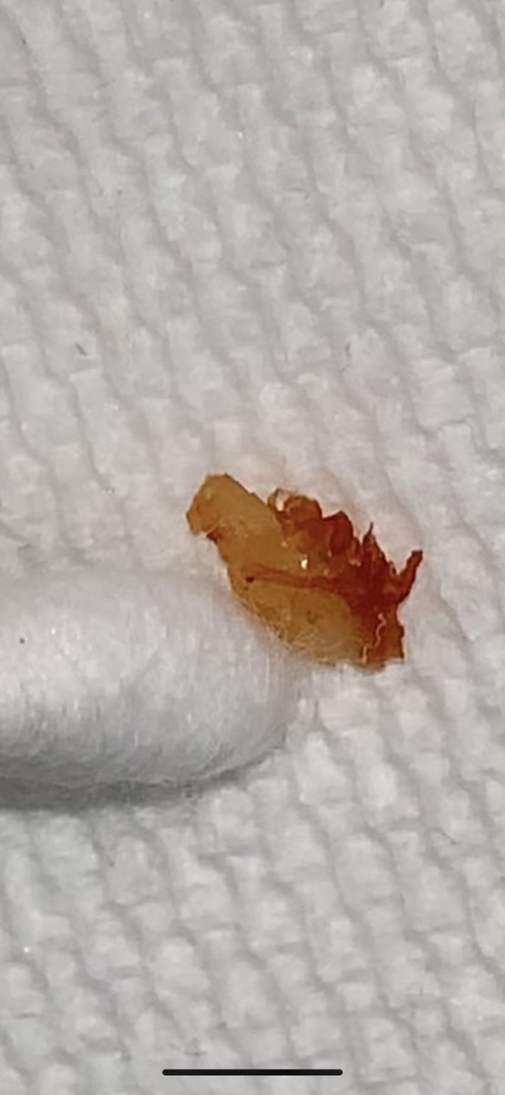 AshleyBuckeye's tweet photo. .
Please help. 
@UDNconnect
@CDC_eHealth

#morgellons is real. https://t.co/6zrVPaFOpy