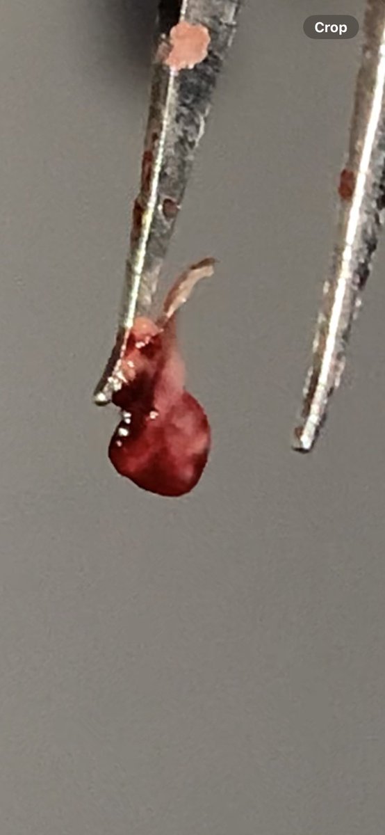 AshleyBuckeye's tweet photo. .
Please help. 
@UDNconnect
@CDC_eHealth

#morgellons is real. https://t.co/6zrVPaFOpy
