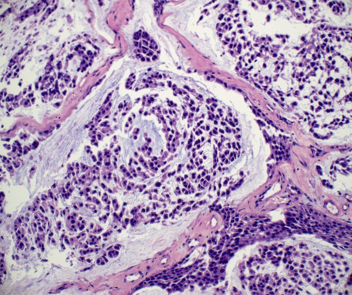 slusagar's tweet photo. #GUpath TURBT:

while not a formal urothelial carcinoma subtype (yet!), urothelial carcinoma with myxoid stroma/chordoid features effectively describing same entity with different names: 
PMID: 19542871, 19535127

most recently, we've added a series incorporating molecular!⏬ https://t.co/tjrXtmUgEK