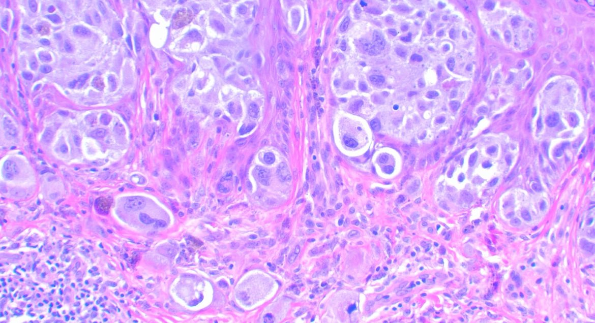 Spitzoid melanoma

Atypical lesion showing large, atypical melanocytes, often with abundant cytoplasm and large, vesicular nuclei

#path #pathology #dermpath #medicine
