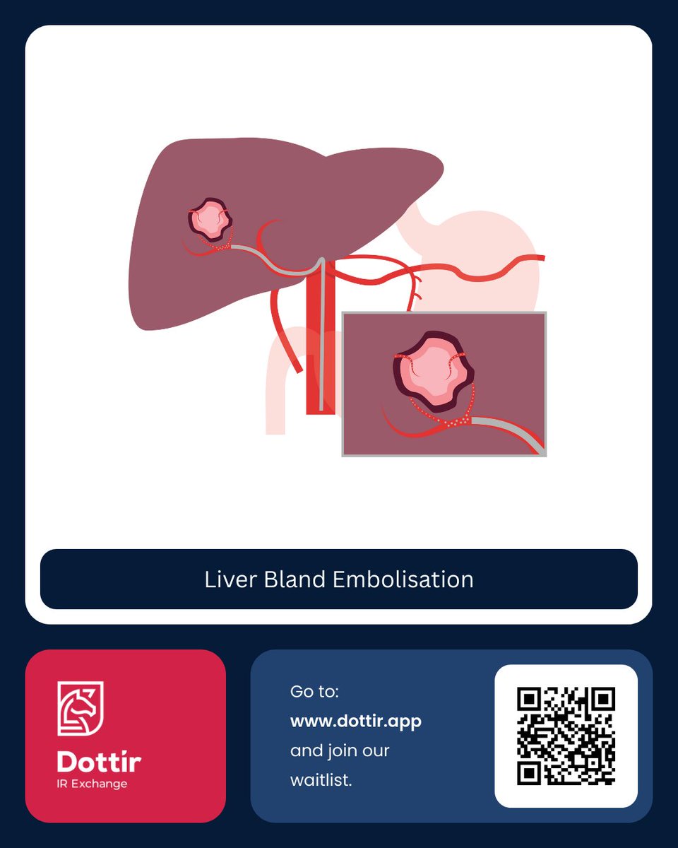 Liver embolisation (TAE) is a minimally invasive IR procedure for liver tumours. Using a catheter + microparticles, blood supply to the tumour is blocked, slowing growth. Unlike TACE, no chemo drugs are used. Often an option when surgery isn’t suitable. #Dottir