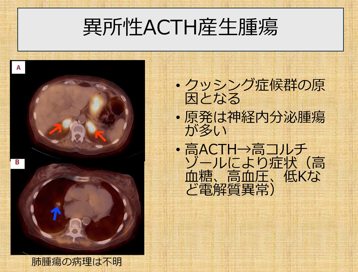 38♥♥♥♥食道腫瘍の臨床病理♥♥♥♥ 38♥♥♥♥食道腫瘍の臨床病理♥♥♥♥