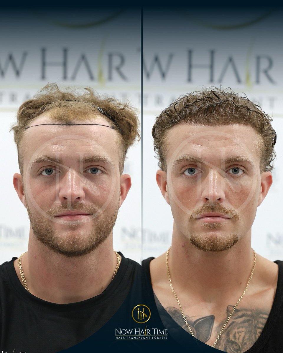 Hair Transplant Results!   #hairtransplant #hairtransplantation #hairtransformation #hairtransplantclinic #hairjourney #hairtreatments #hair #beforeafterhair #hairgoals #haircarespecialist #haircarespecialist #trapiantocapelli #trapiantodicapelli