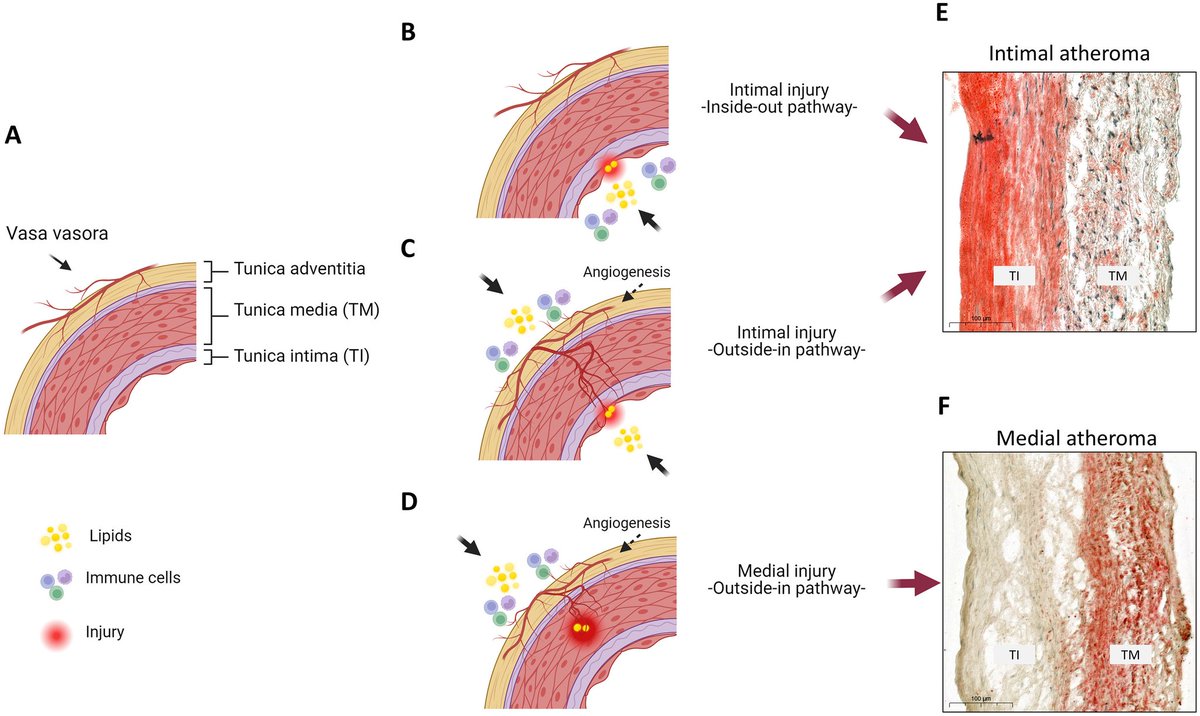 "25 human carotid endarterectomy"
 
"32% of plaques contained higher atheroma in the tunica media than in the tunica intima"

"Plaques with medial atheroma revealed an accumulation of lipids in tunica media, whereas thickened tunica intima remained free of lipids"