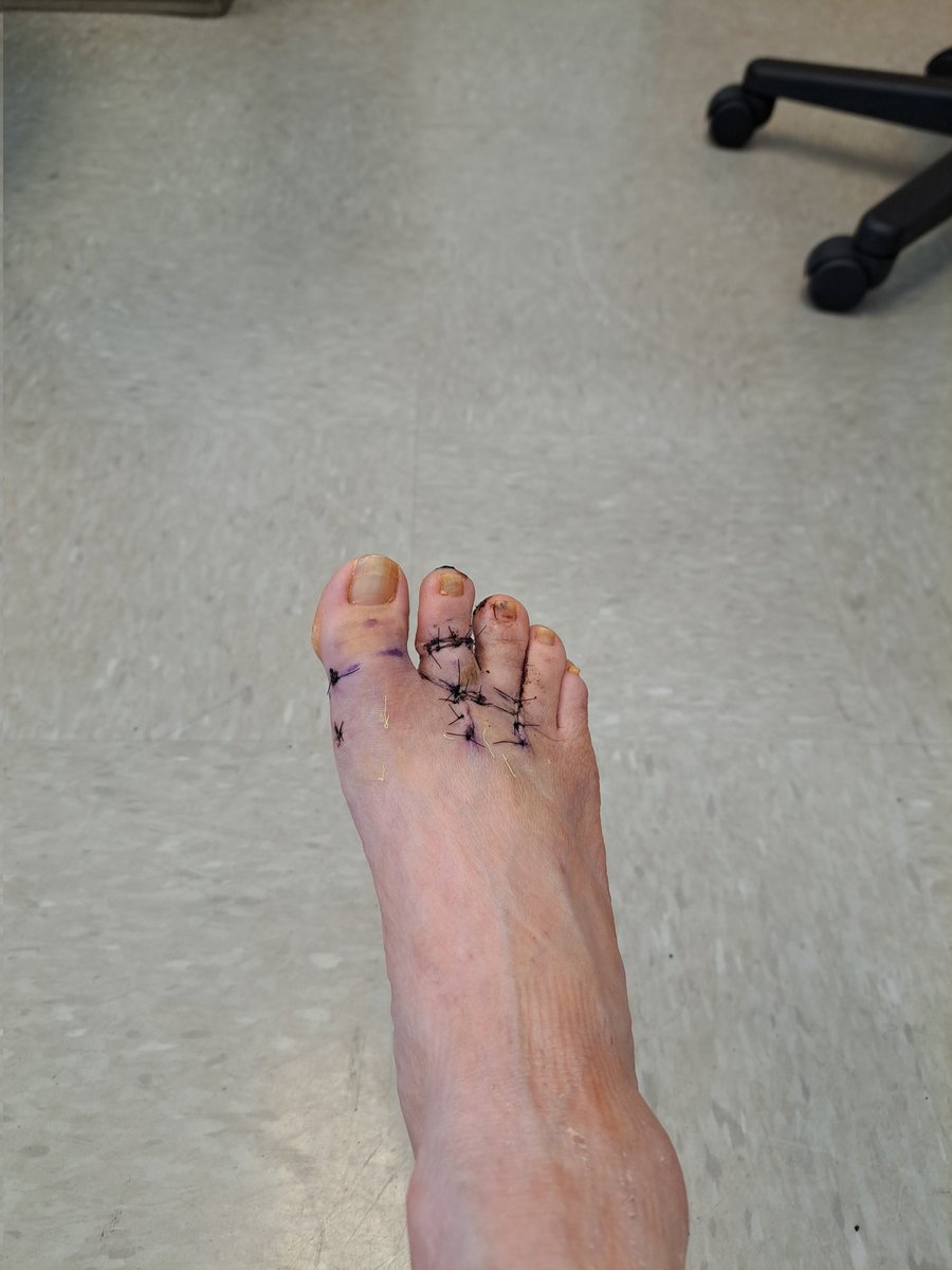 I still need $150 for rent. I don't wanna hobble around on this while homeless! If 15 of you put $10 in my tip jar pinned in my profile, that's next month's rent. If 100 of you put $10 in my tip jar, I'd be good until I can go back to work at my job. Thanks, stalkers! You rock!