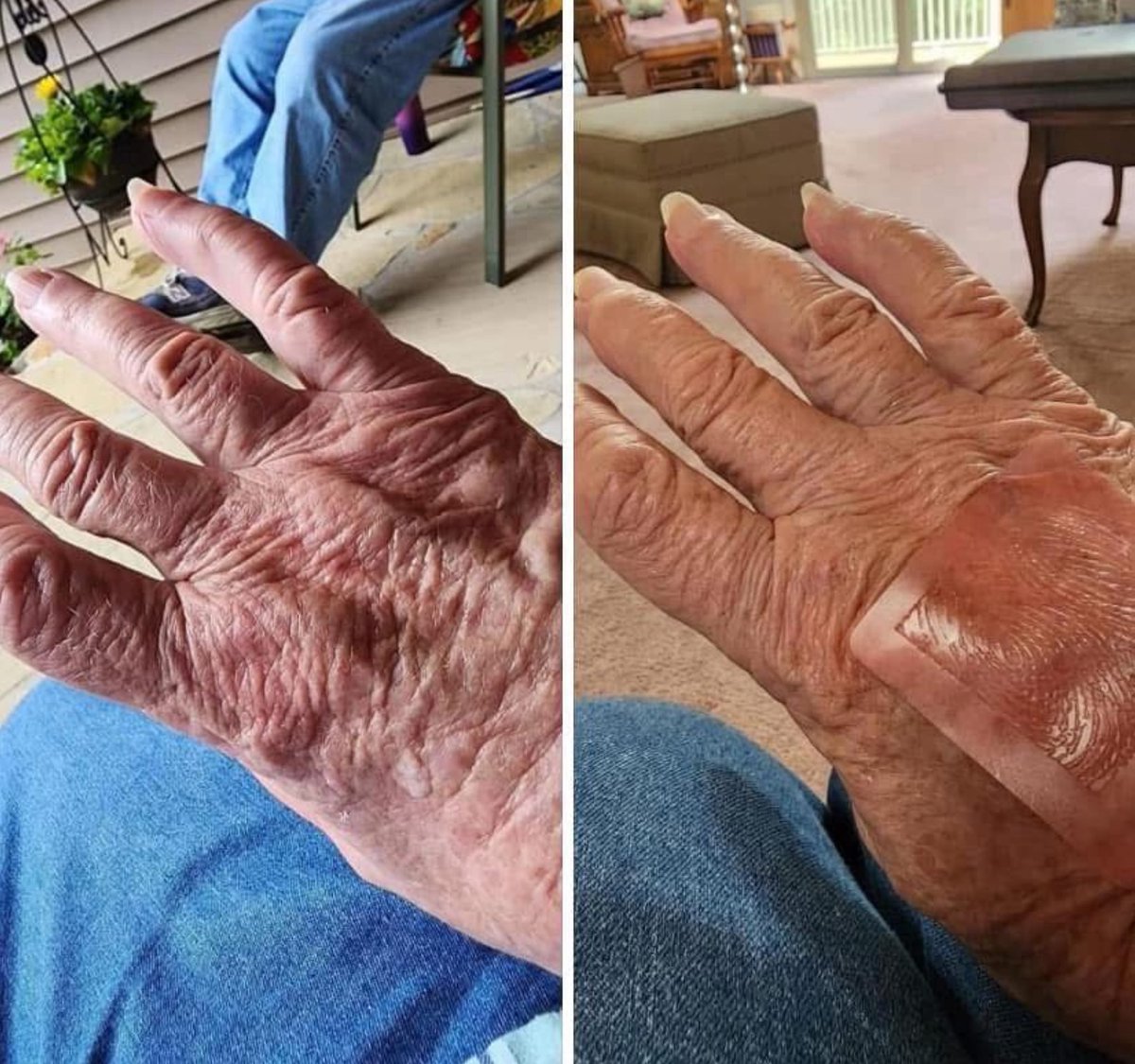 BrittLesley3's tweet image. ✨ Nancy’s Life-Changing Testimonial!  #ArthritisRelief #ArthritisPain #Swelling. Day 1 (no patch) → Pain &amp;amp; swelling in my arthritic hands. Day 4 (with the Freedom Pain Patch) ZERO pain… and the swelling in my fingers has gone down significantly! #superpatch @revspatches.com