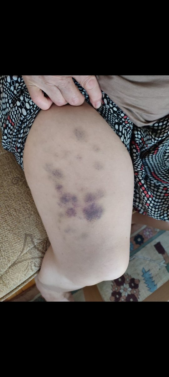 Denizli'nin ortasında 65 yaşındaki kadının,bodrumu kilitleyip kaçak alkol yaptığı icin polise ihbar ettiği gerekçesiyle kapısının önünde üst komşusu trafındn darp edildiği ve suçlunun aynı aileye karşı 6 davası olmasına rağmen hala tehditlerine devam ettiği bir dünya
<a href="/yilmaztunc/">Yılmaz TUNÇ</a>