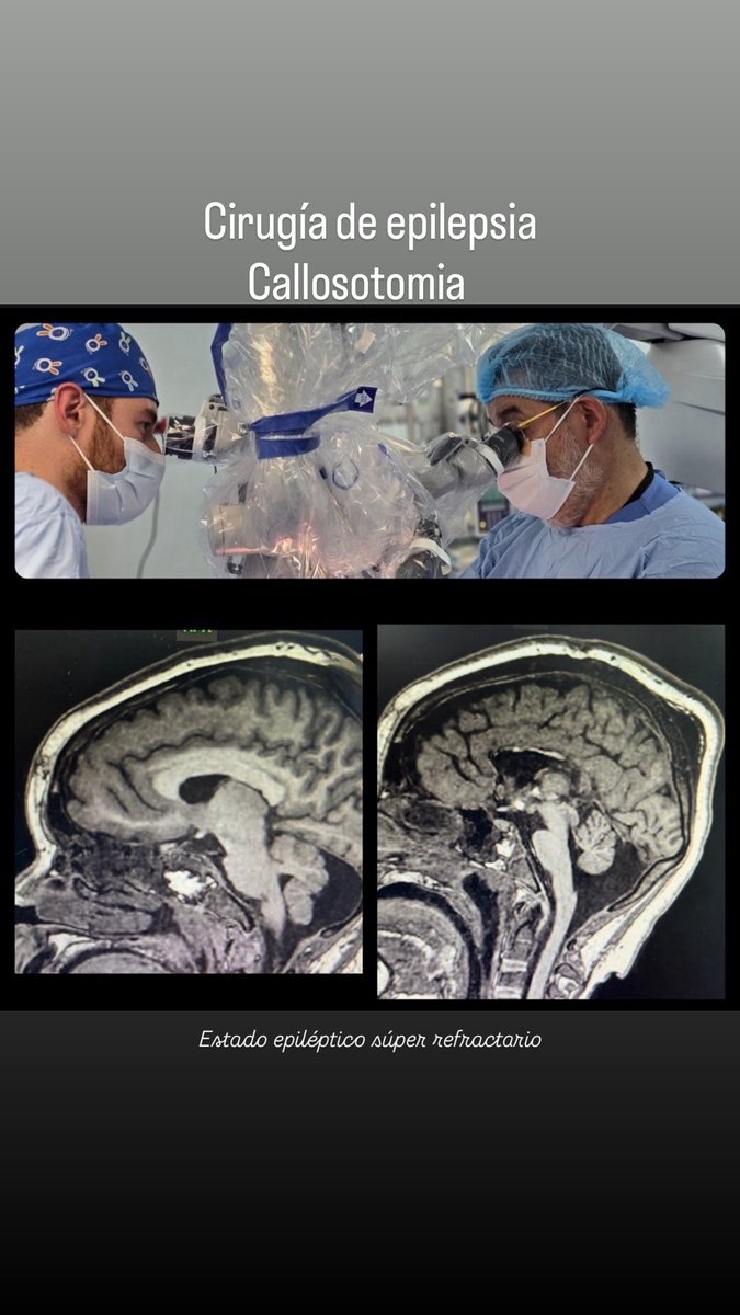 DROSCARZORRO's tweet image. Callosotomia como opción terapéutica en epilepsia refractaria, con indicaciones precisas mejoría en el control de crisis y calidad de vida de pacientes y cuidadores.
Caso de estado epiléptico súper refractario.