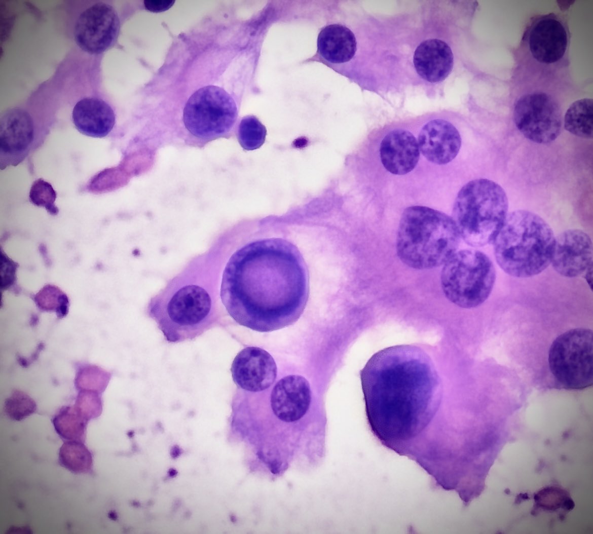 SaeedAsiry's tweet image. A photogenic nuclear pseudoinclusion in a meningioma smear! #pathart #neuropathology #neurocytology