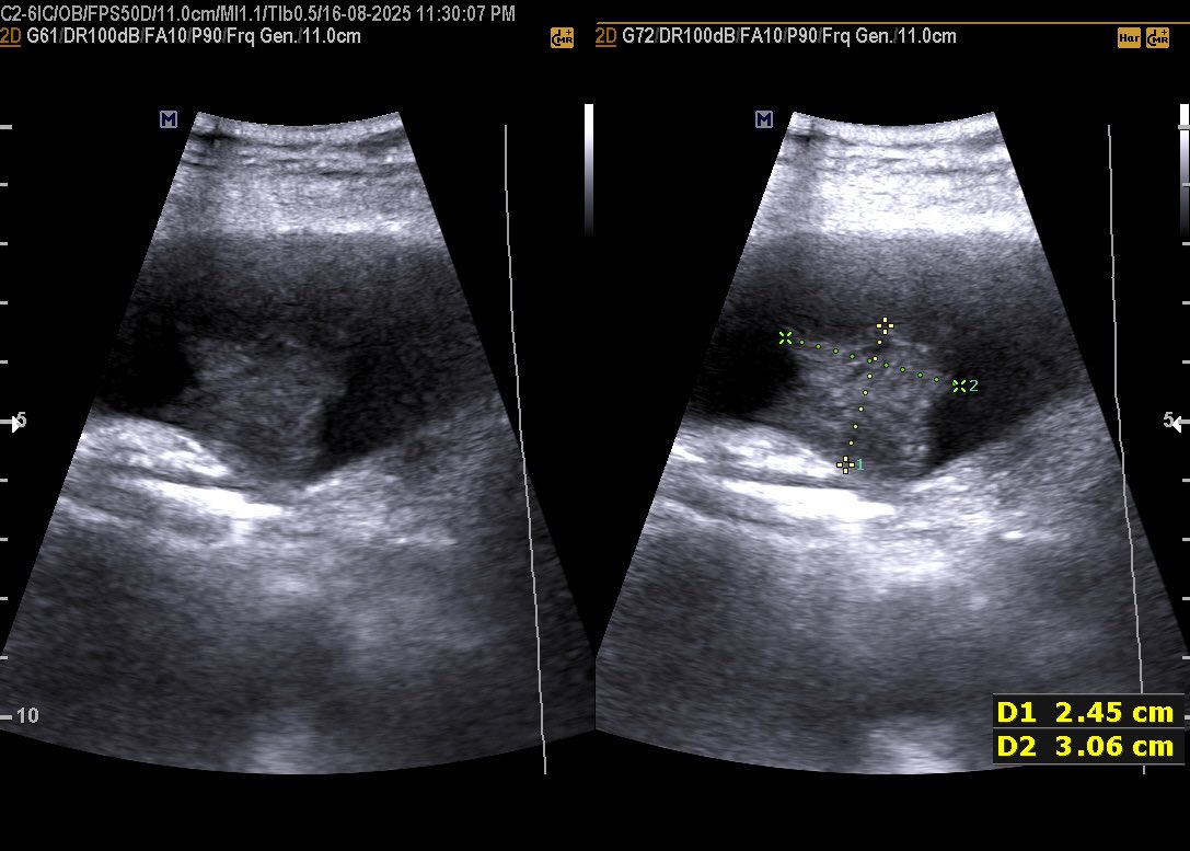 EchoTech_4's tweet image. Known case of ovarian cancer in 70 years female patient presented with SOB.

Your opinion?

#EchoTech