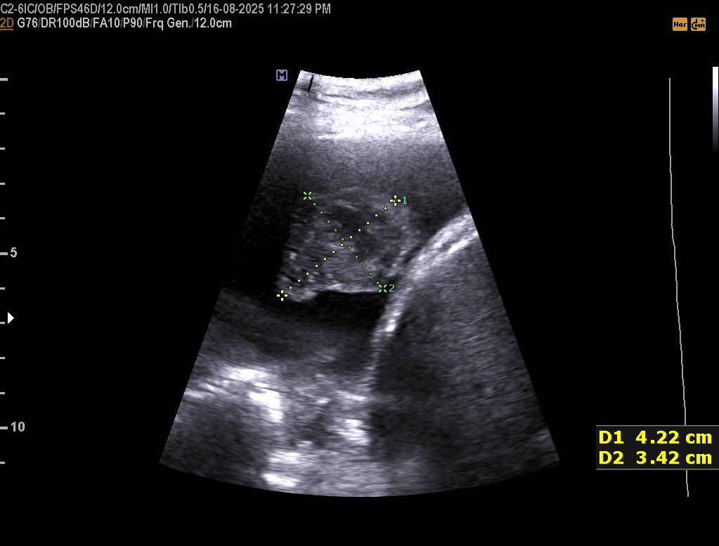 EchoTech_4's tweet image. Known case of ovarian cancer in 70 years female patient presented with SOB.

Your opinion?

#EchoTech