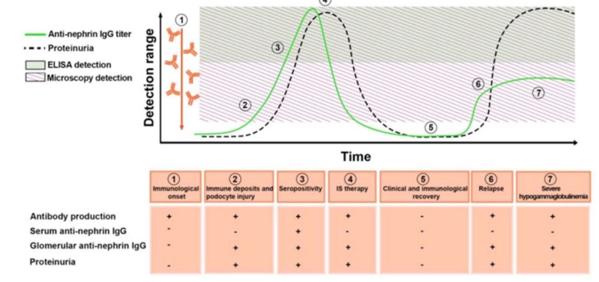 Paola Romagnani (@promagnani) on Twitter photo Can anti-nephrin, anti-podocin & anti-Kirrel1 antibodies guide diagnosis & therapy in podocytopathies?
Our new review in NDT dives into the biological hurdles & clinical implications.
 academic.oup.com/ndt/advance-ar… Can anti-nephrin, anti-podocin & anti-Kirrel1 antibodies guide diagnosis & therapy in podocytopathies?
Our new review in NDT dives into the biological hurdles & clinical implications.
 academic.oup.com/ndt/advance-ar…