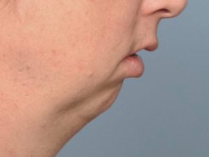 "bro it's just a chin"