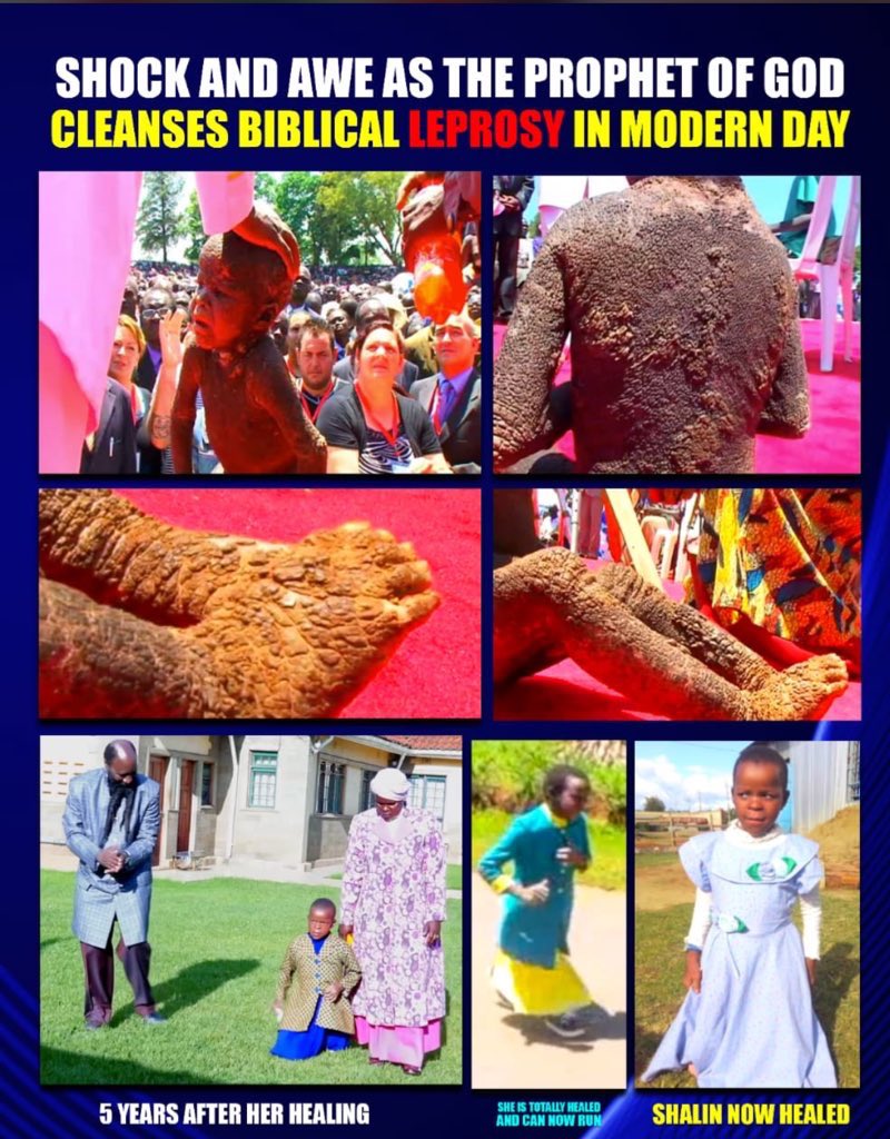 MekeNambala's tweet photo. Shalin Chepkirui, a powerful testimony
of the healing power of the LORD.

From a young age, she suffered the shame and discomfort of leprosy, but in 2012, at Bukhungu Stadium in Kakamega, the Lord touched her, and she was completely healed.

Glory To GOD!
 #MightyHourOfRevival https://t.co/PDZFh9sqi1