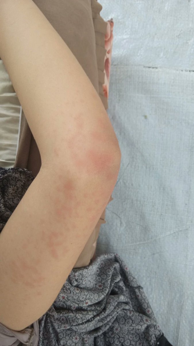 raghadkadash (@raghadkada77383) on Twitter photo "My sisterโs allergy is getting worse day by day ๐ Please help me continue her treatment. I urgently need only $175 ๐
chuffed.org/project/130466
<a href="/roundthefurr/">shayma</a>
<a href="/MothTongue_/">๐๐ปูุณุงู ุงูุนุซุฉ @gazafunds.com</a>
<a href="/1drcole/">Dr. Cole #Resister</a> "My sisterโs allergy is getting worse day by day ๐ Please help me continue her treatment. I urgently need only $175 ๐
chuffed.org/project/130466
<a href="/roundthefurr/">shayma</a>
<a href="/MothTongue_/">๐๐ปูุณุงู ุงูุนุซุฉ @gazafunds.com</a>
<a href="/1drcole/">Dr. Cole #Resister</a>