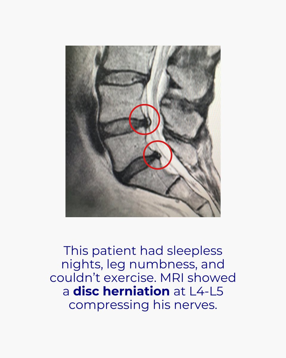 JDchiro's tweet image. Can’t walk. Can’t sleep. Can’t run.

When pain takes control of your life, everything feels harder.

But you don’t have to live like this. Relief is possible 💪✨

👉 Book your consultation today and start taking your life back.

#BackPainRelief #SciaticaHelp #SpinalDecompression…